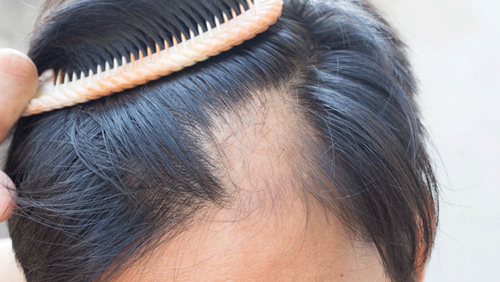 Un casco con láser no invasivo para tratar la pérdida del cabello