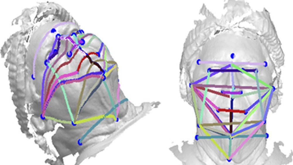 Las fotos faciales en 3D podrían ser una herramienta de detección de apnea del sueño. (Foto. Academia Americana de Medicina del Sueño)