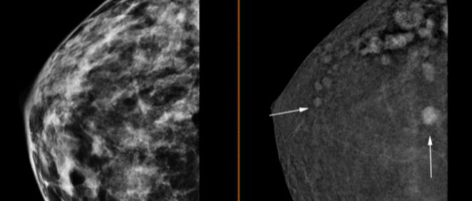 Mamografía 3D con contraste (Foto. Ribera Salud)