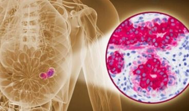 Una mamografía dirigida por resonancia magnética mejora la detección de lesiones mamarias