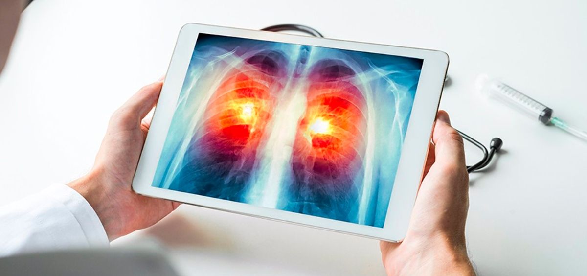 Radiografía digital acerca de un cáncer de pulmón (Foto. US   Archivo  EP)