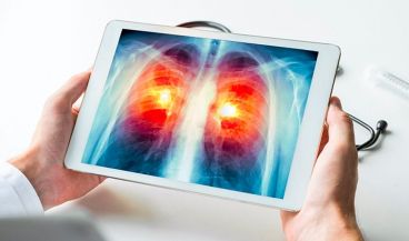 Radiografía digital acerca de un cáncer de pulmón (Foto. US   Archivo  EP)