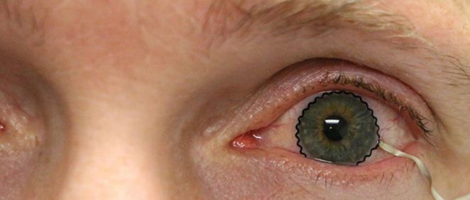 Lente de monitorización ocular (Foto. Purdue Mechanical Engineering)