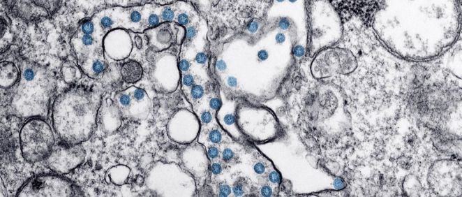 Partículas del virus SARS CoV 2, coloreadas en azul, en una imagen de microscopio de electrones.  (Foto. CDC)