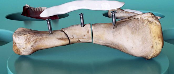 El método quirúrgico alternativo combina tornillos con una acumulación del material compuesto (Foto. KHT Royal Institute of Technology)