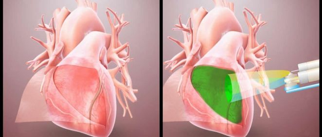 Los investigadores han desarrollado un dispositivo que rocía de manera segura y precisa el hidrogel dentro del área donde se realiza la cirugía a corazón abierto (Foto: University of California San Diego)