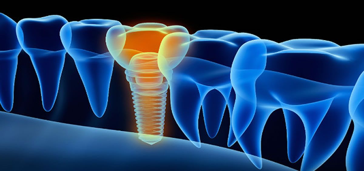 Implantes dentales inteligentes