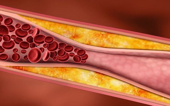 Nano drones en la sangre para prevenir infartos