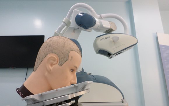 La revolución del trasplante capilar: Sin cicatrices y con visión previa 3D