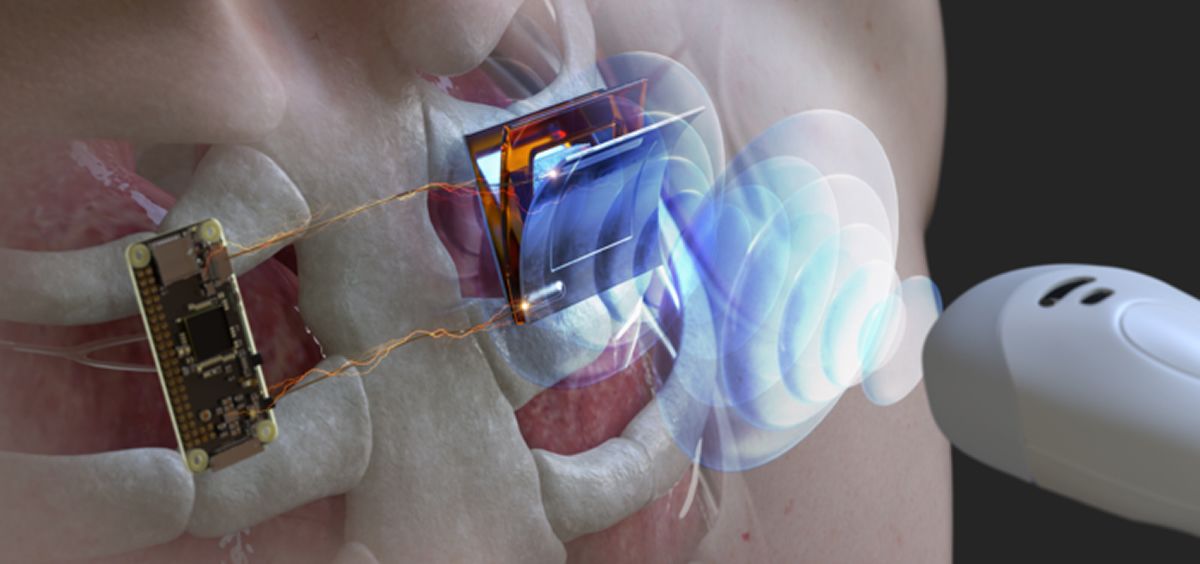 Ilustración esquemática de la carga inalámbrica de un dispositivo electrónico implantado en el cuerpo mediante una sonda ultrasónica (Foto. Instituto de Ciencia y Tecnología de Corea (KIST))