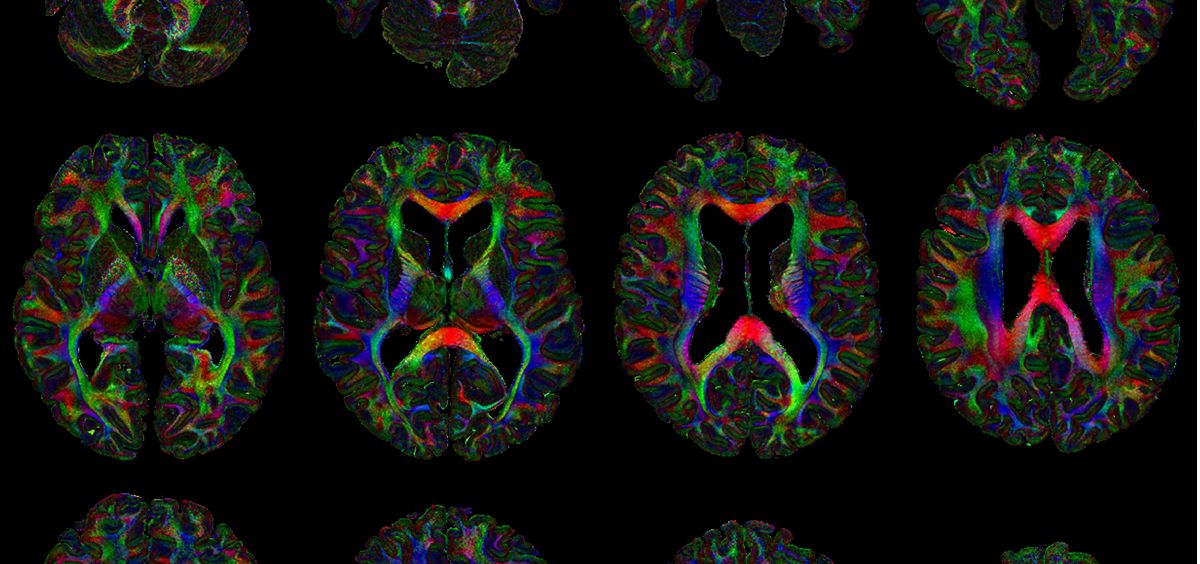 Neuroimagen de un cerebro completo perteneciente a los documentos del banco (Foto. The Digital Brain Bank)