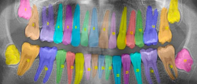 Inteligencia artificial para analizar radiografías dentales (Foto. MIT)