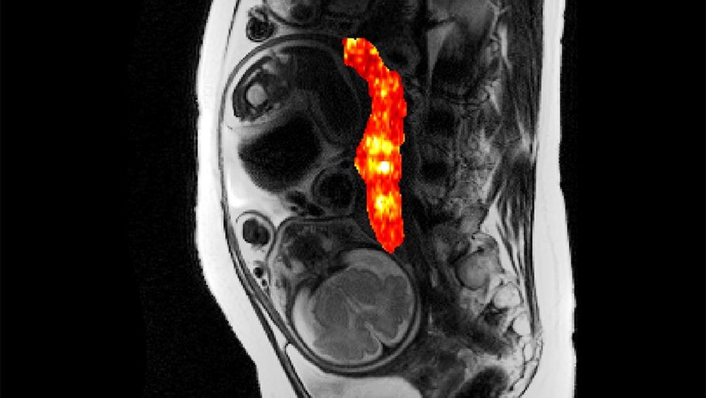 Resonancia magnética de la placenta (Foto: OHSU)