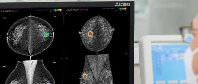 Mamografía realiza con el software de inteligencia artificial LUNIT (Foto. Ascires Grupo Biomédico)