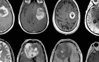 Tumor cerebral agresivo mapeado en detalle genético y molecular, neurofibromatosis (Foto. EP)