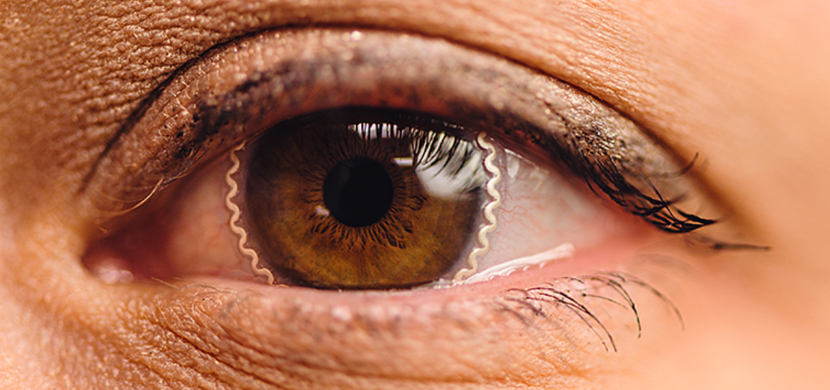 Lentillas inteligentes que permiten prevenir y tratar el glaucoma. (Fuente: Purdue)
