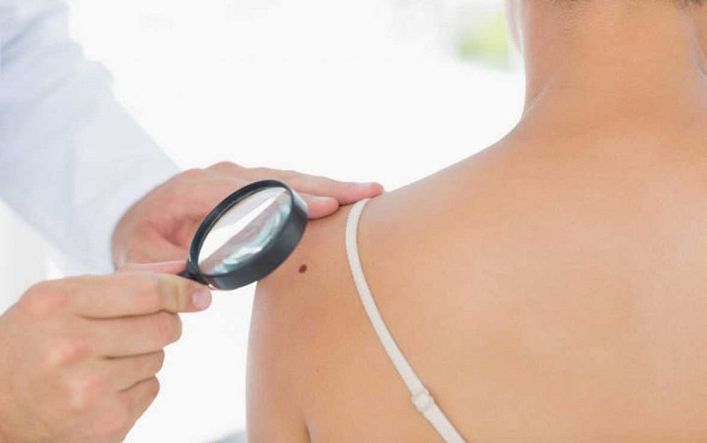 Imágenes dermatoscópicas para categorizar la gravedad del melanoma