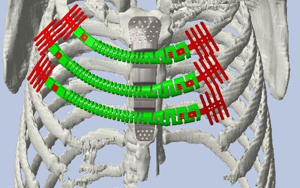 Diseños biomecánicos, la última evolución en impresión 3D aplicada a la cirugía torácica
