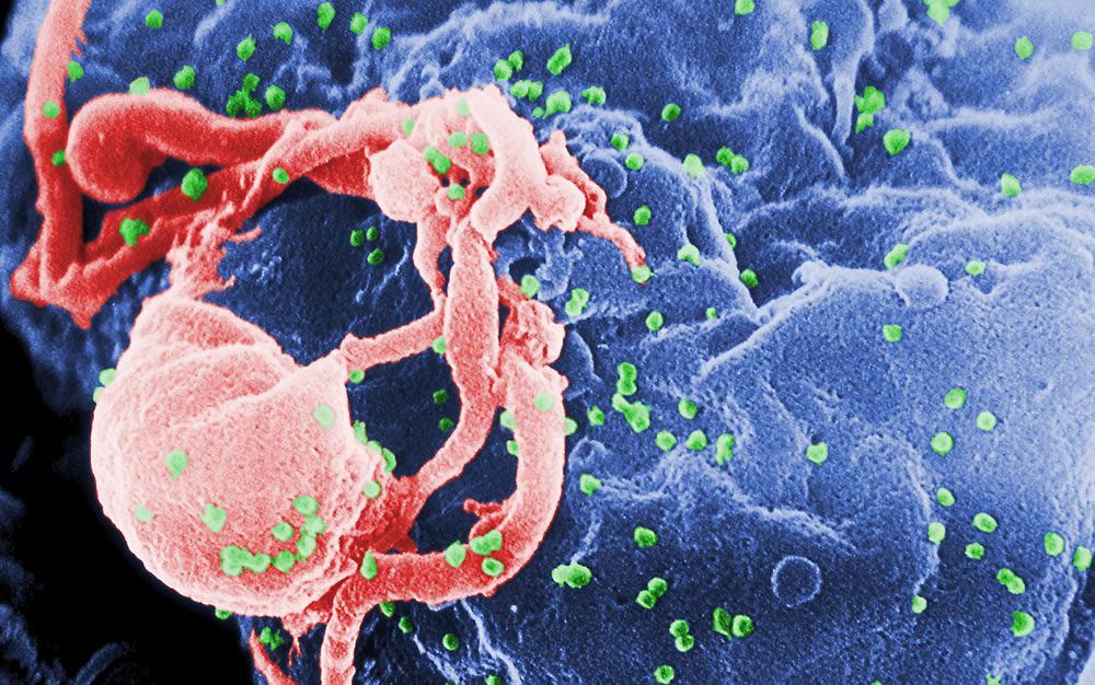 Lograr una cura funcional y erradicar el VIH: ¿posible con ingeniería genética?