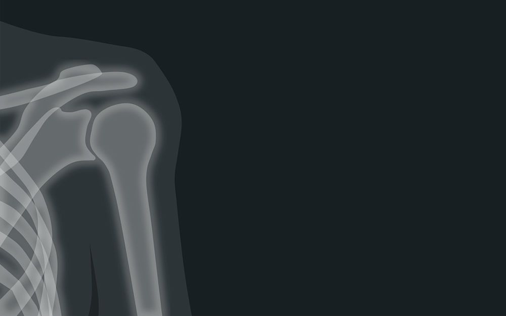 Diseñan un modelo informático para mejorar el hombro en pacientes con artroplastia