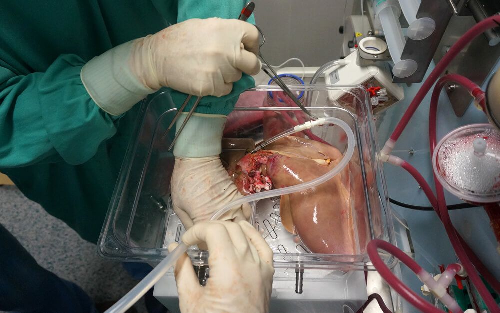 La normotermia, técnica revolucionaria para trasplantar órganos en funcionamiento