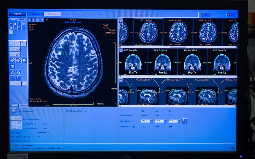 Avance en alzhéimer: ultrasonidos sobrepasan barrera hematoencefálica