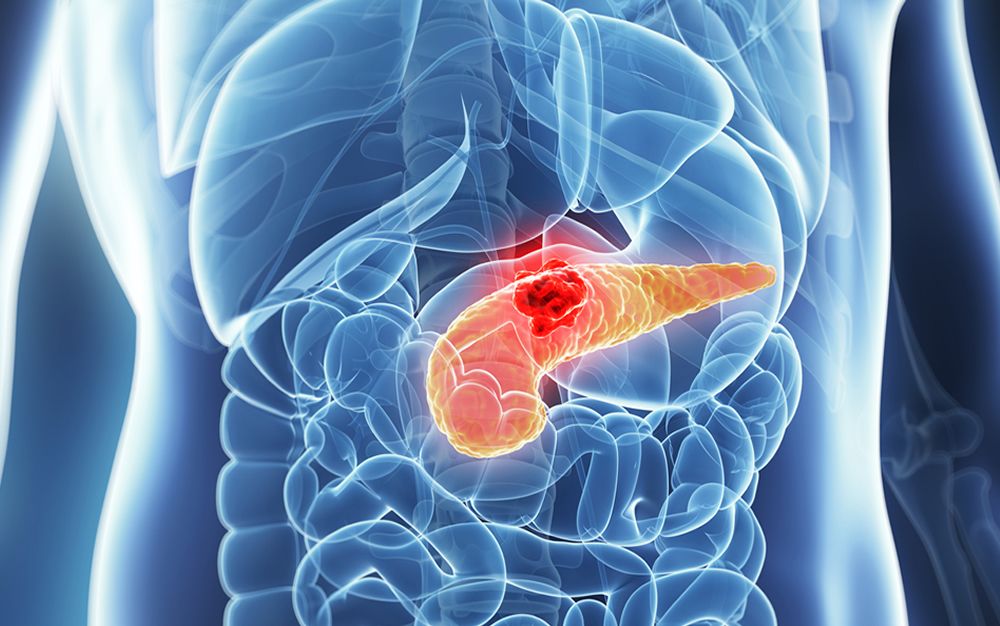 La radiofrecuencia con ecoendoscopia abre nuevas vías en el cáncer de páncreas