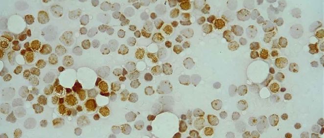 En color marrón, células cancerosas en leucemia mieloide aguda resistente a fármaco citarabina (Foto: Hospital Universitario 12 de Octubre)