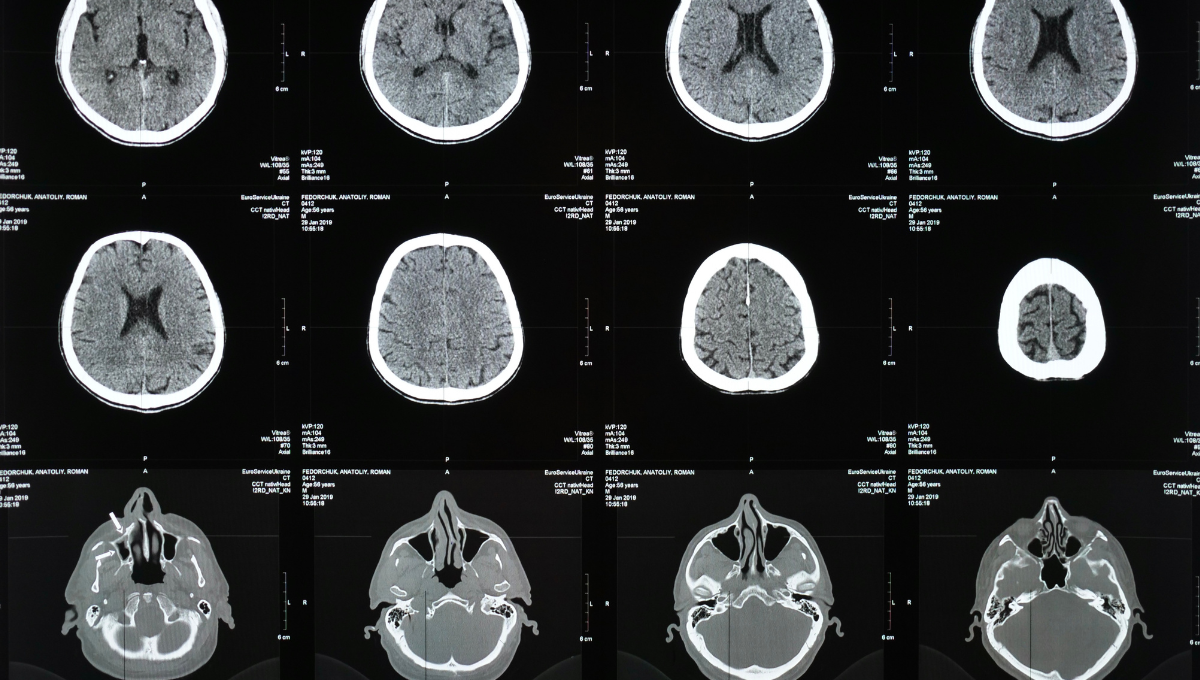 Escáner del cerebro (Foto. Canva)