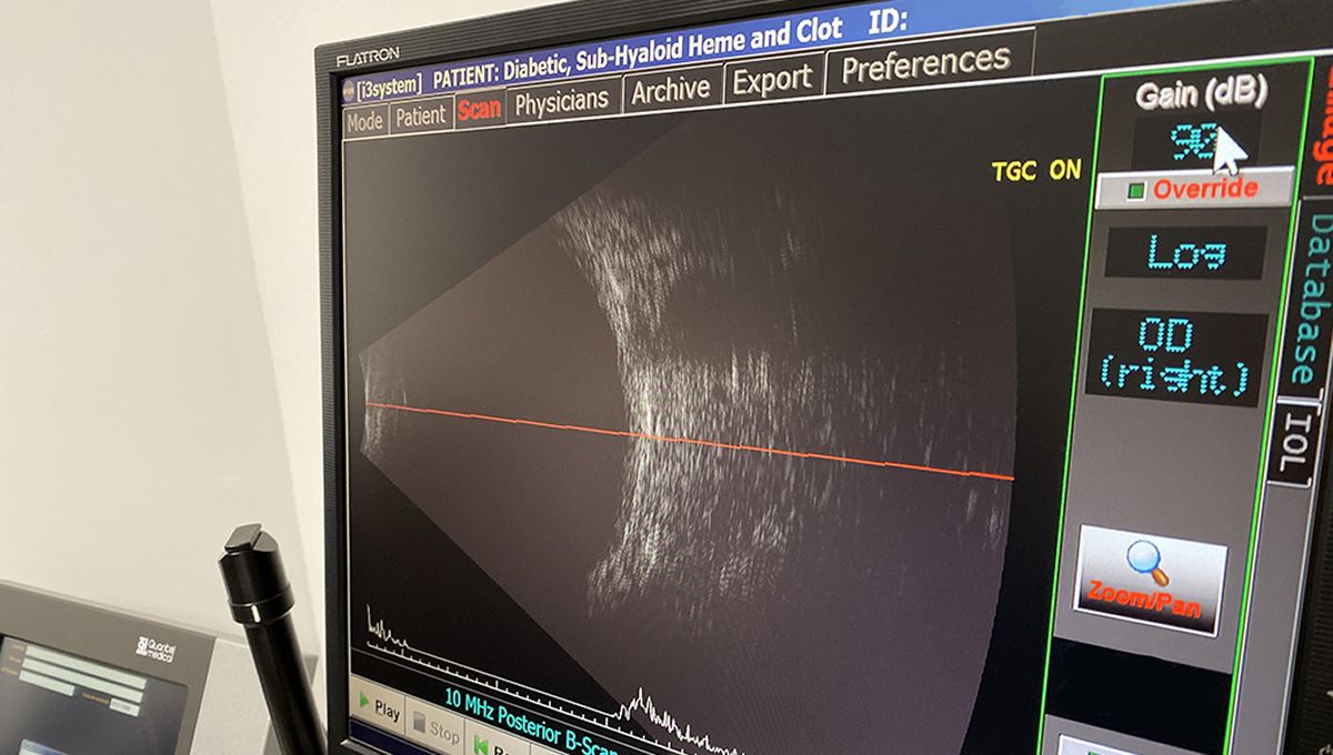 Resultados de una ecografía ocular para detectar fallos en las derivaciones ventriculares de los niños (FOTO: Estudio Oftalmológico)