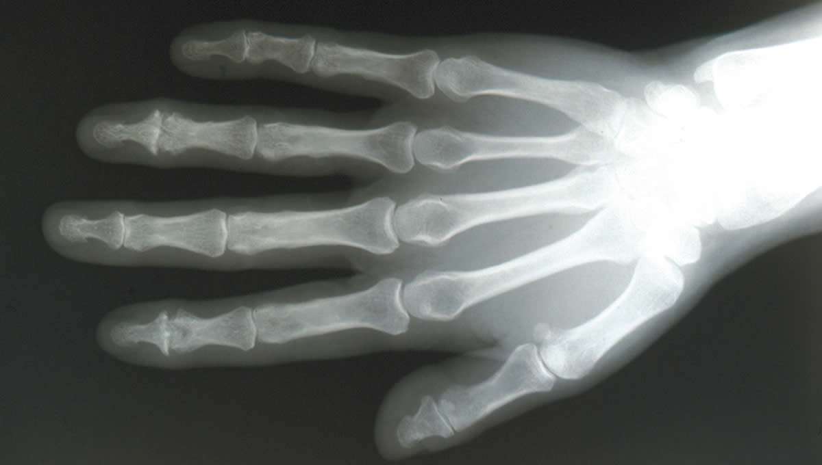 Radiografia de una mano