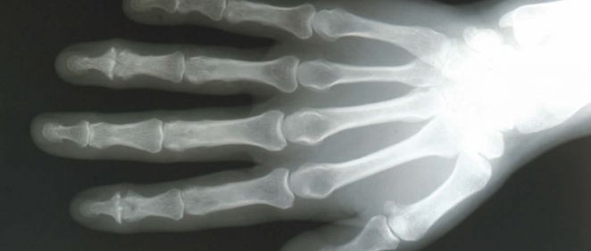Radiografia de una mano