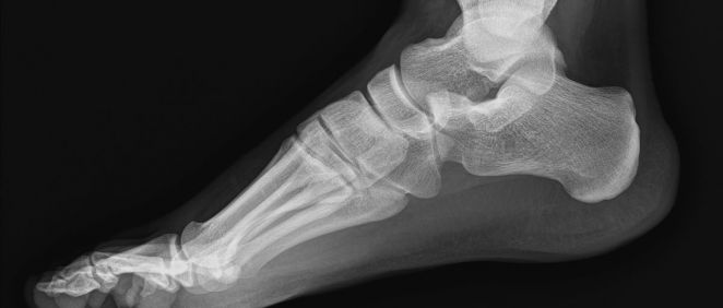 Radiografía de un pie