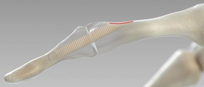 Tornillo quirúrgico diseñados a partir de muestras donadas de fémur humano