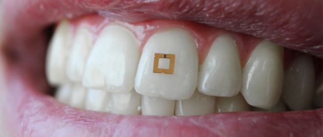 Uno de los sensores, integrado en un diente, desarrollado por el equipo de investigadores de la Universidad Tufts