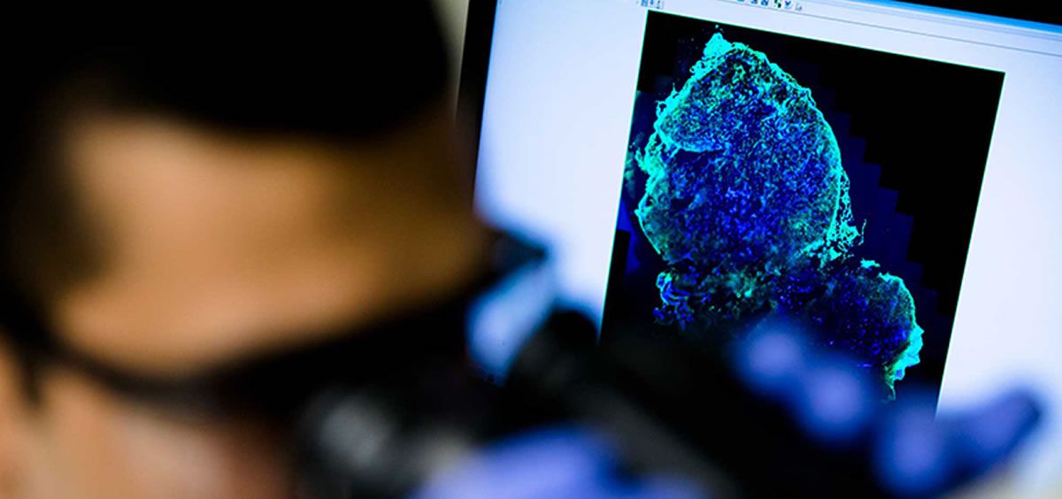 Las partículas fluorescentes permiten vislumbrar las células cancerosas