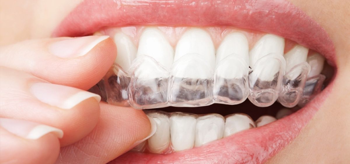 Un nuevo recubrimiento para alineadores dentales evita las bacterias