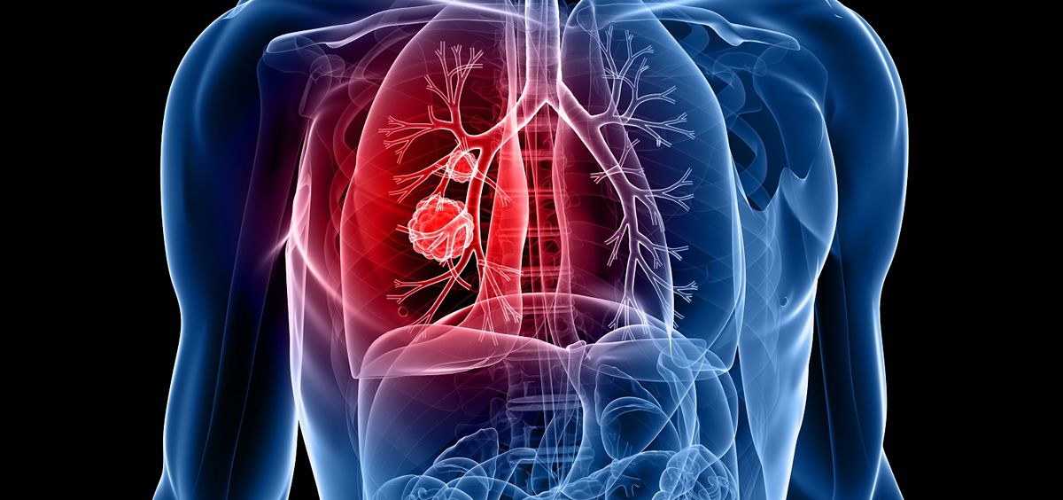 Inteligencia artificial para tumores pulmonares