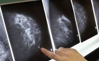 El 80% de las mujeres con cáncer de mama supera la enfermedad