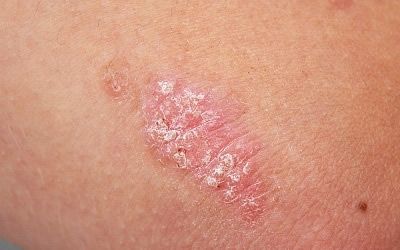 Pfizer imparte un taller sobre psoriasis en la 41 edición del congreso de la AEDV