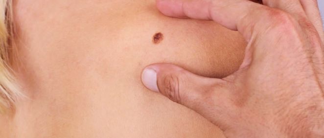 Una prueba pionera detecta el riesgo de propagación del melanoma (Foto de Freepik)