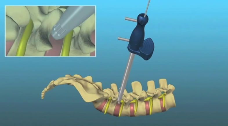 Nueva cirugía endoscópica de fusión de la columna vertebral (Foto. Quirónsalud)
