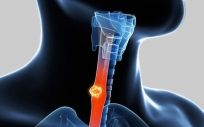 La enfermedad por reflujo ácido puede aumentar el riesgo de cáncer de laringe y esófago