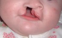 Bebé con labio leporino (Foto. Wikipedia)