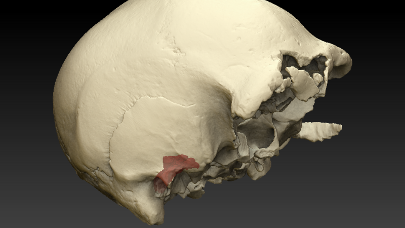 Exostosis en el Cráneo 4 de la Sima de los Huesos (Foto. ConSalud)