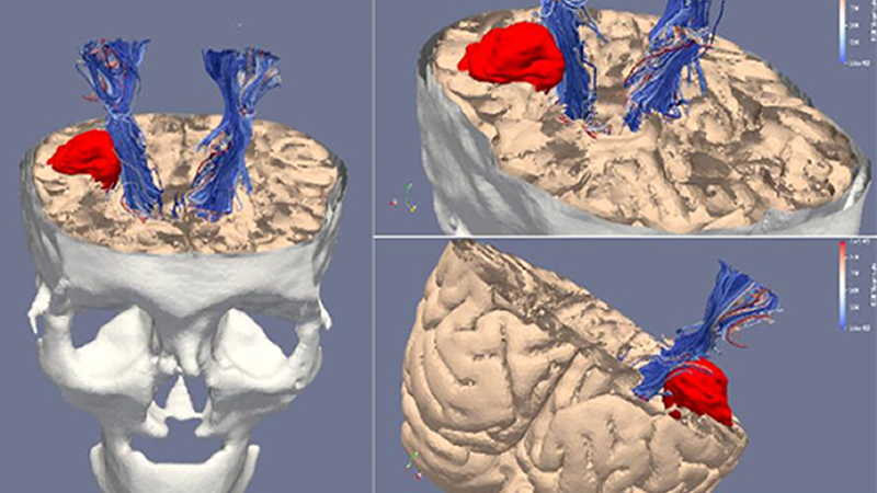 Recreación del cráneo, el tumor y el haz cortico espinal del paciente (Foto. Junta de Andalucía)