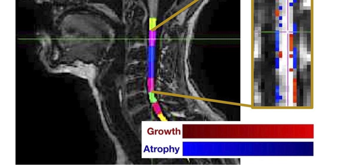Imagen obtenida para la observación del grado de atrofia de la médula espinal (Foto de la UOC)