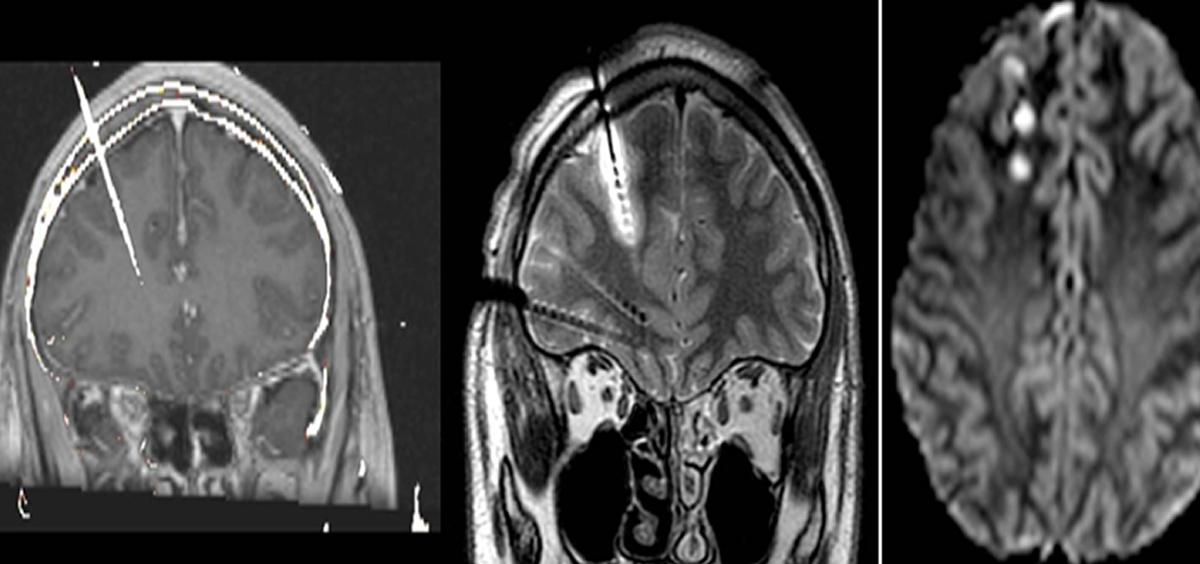 Imágenes de una resonancia magnética que muestran el procedimiento de esta técnica (Foto. ConSalud)