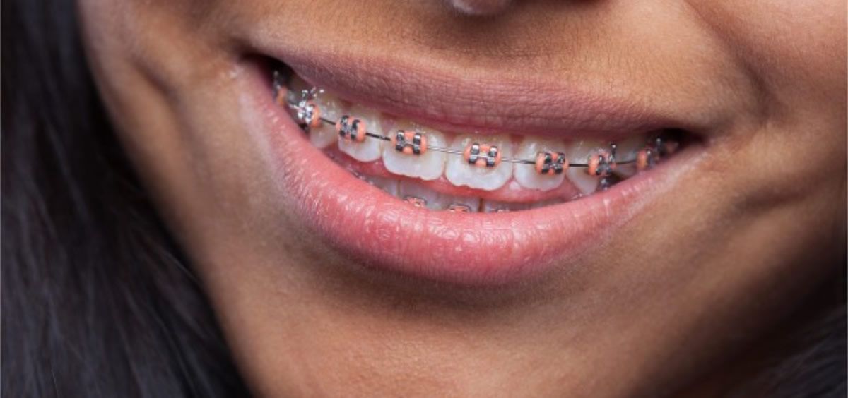 La ortodoncia es más común en adolescentes, pero la edad puede variar según el problema dental y la gravedad (Foto. Freepik)
