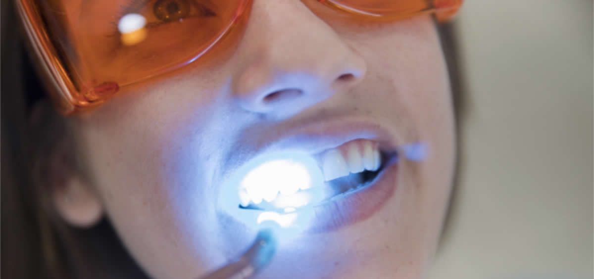 Mujer realizándose un blaqueamieno dental (Foto. Freepik)